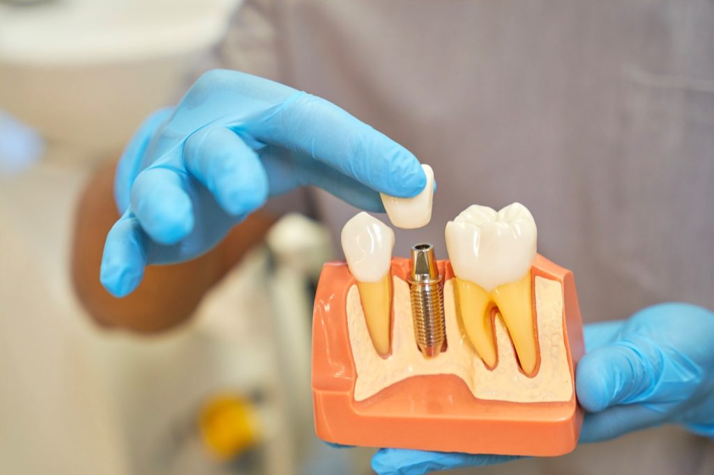 Costs of Dental Implants